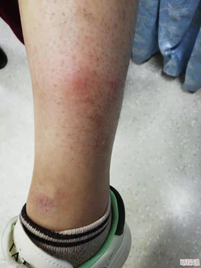 淑芬俩腿间又痒了医生说是过敏开了药膏并嘱咐她注意卫生