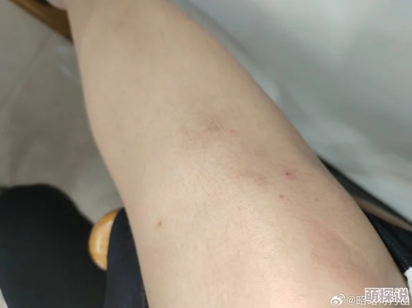 淑芬俩腿间又痒了医生说是过敏开了药膏并嘱咐她注意卫生