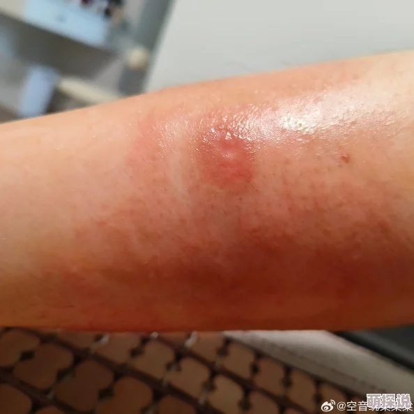 淑芬俩腿间又痒了医生说是过敏开了药膏并嘱咐她注意卫生