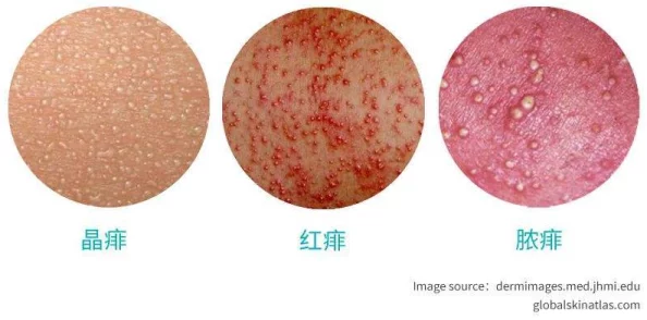 龟头上长了像痱子一样的据说是单身久了内分泌失调惹的祸